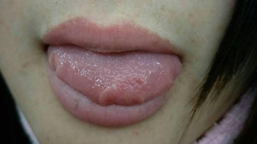 「舌头上长泡是什么原因」吃芒果舌头上长泡是什么原因