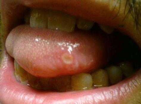 「舌头上长泡是什么原因」吃芒果舌头上长泡是什么原因