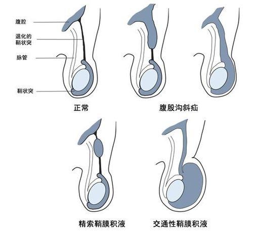 「鞘膜积液症状」鞘膜积液症状和腹股沟疝的区别