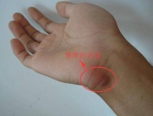 「鼠标手症状」鼠标手症状及治疗方法右手无名指跟手掌连接处长老茧