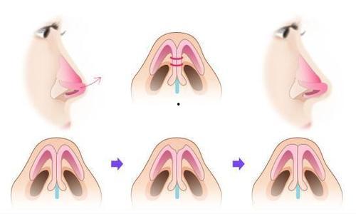 「假体隆鼻的副作用」假体隆鼻子的危害