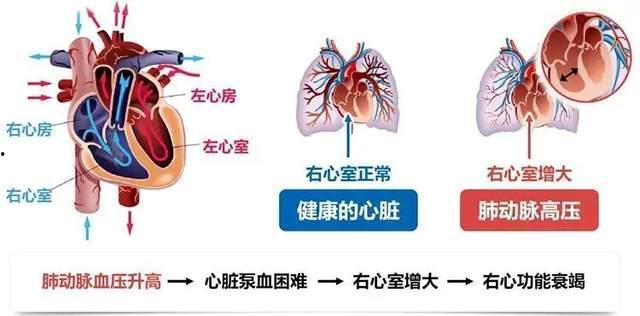 「先天性心脏病的症状」先天性心脏病的症状有哪些图片