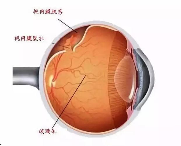 「视网膜脱落症状」视网膜脱落症状及原因